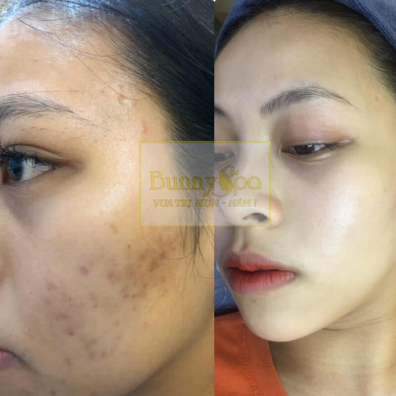 Bunny Spa - Vua trị mụn, nám