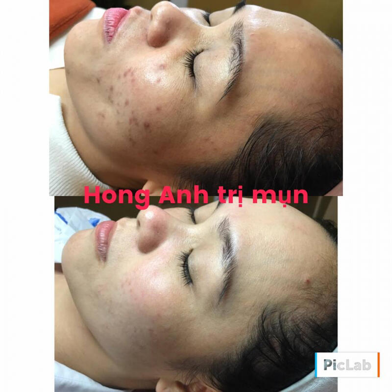 Hồng Anh - Đặc trị mụn
