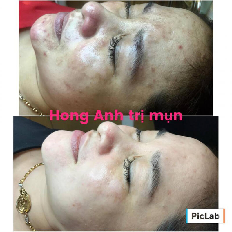 Hồng Anh - Đặc trị mụn