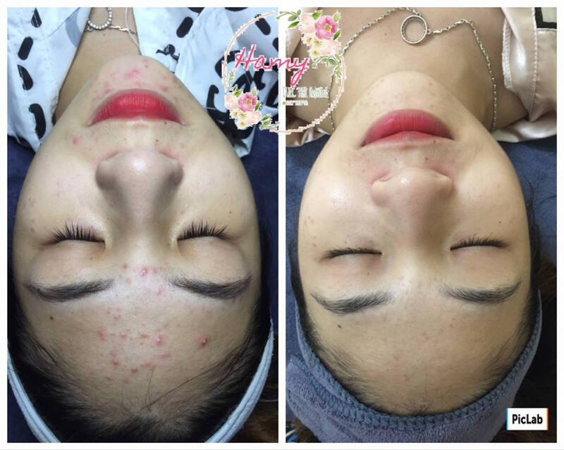 Hamy - Đặc Trị Mụn (Thu Hà)