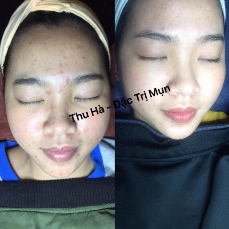 Hamy - Đặc Trị Mụn (Thu Hà)