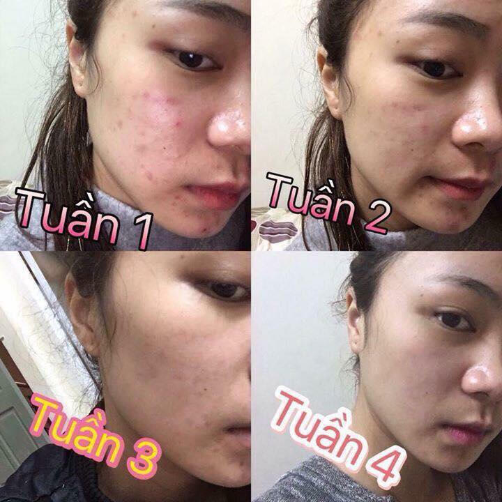 Ong Liên Spa - Đặc trị mụn