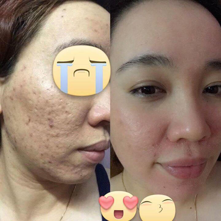 Ong Liên Spa - Đặc trị mụn