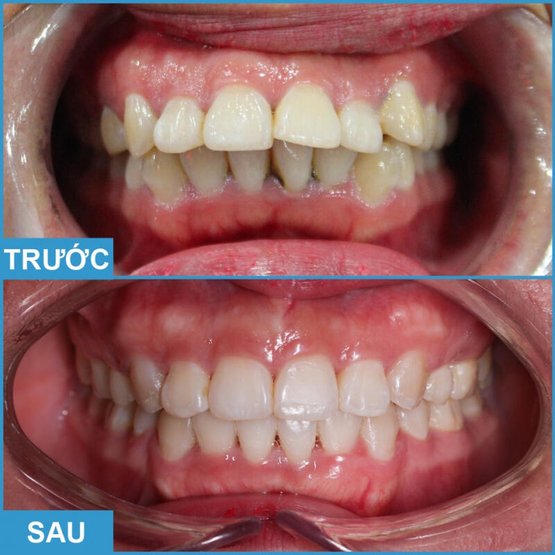 Nha Khoa Lạc Việt Intech Vinh